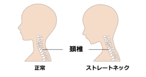 ストレートネックの図解