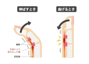 ばね指の原因と症状