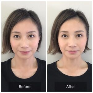美容鍼ビフォーアフター写真②