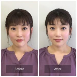 美容鍼　ビフォーアフター写真➀