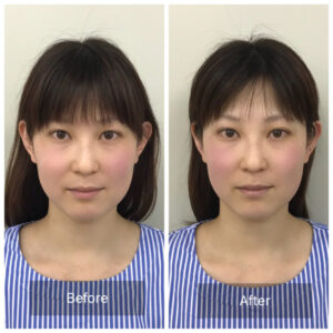 美容鍼ビフォーアフター